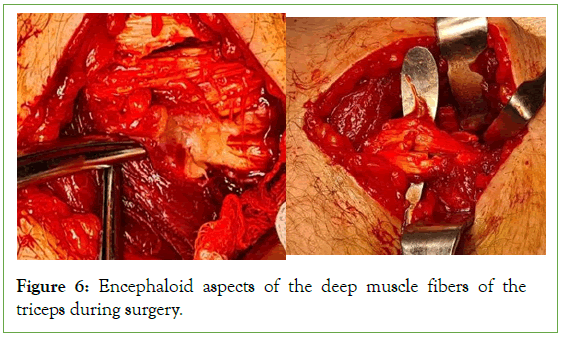 tumour-research-Encephaloid