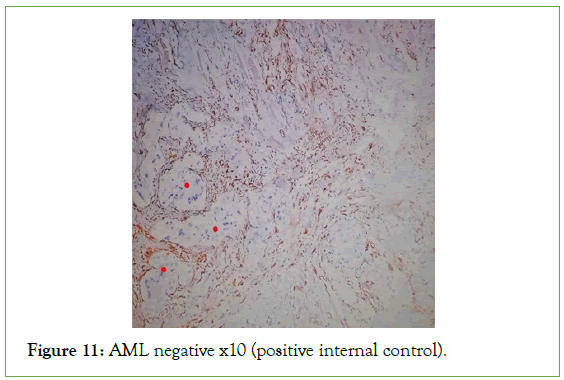 tumour-research-negative