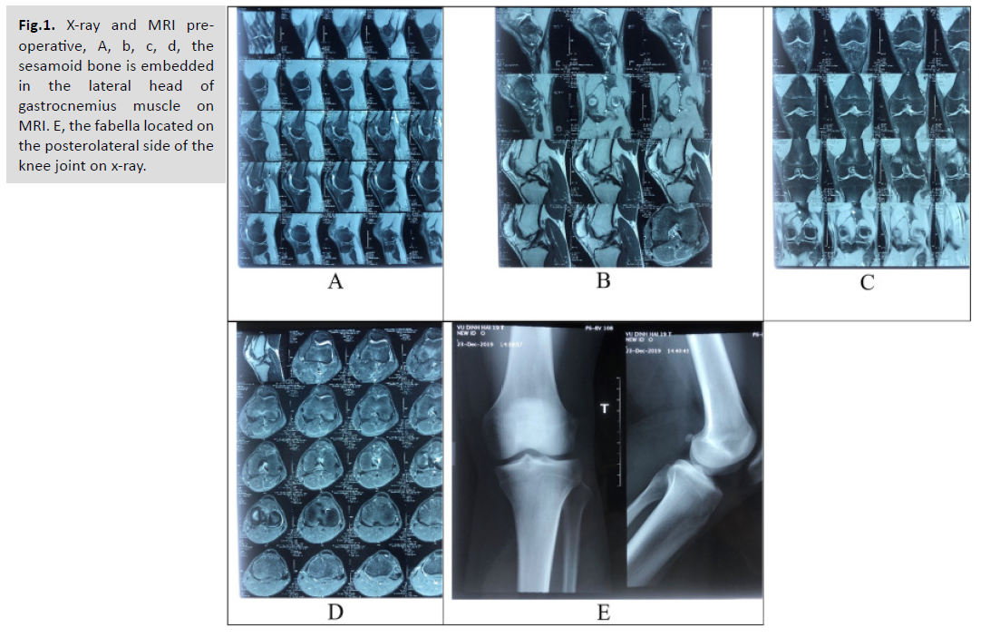 universal-surgery-sesamoid