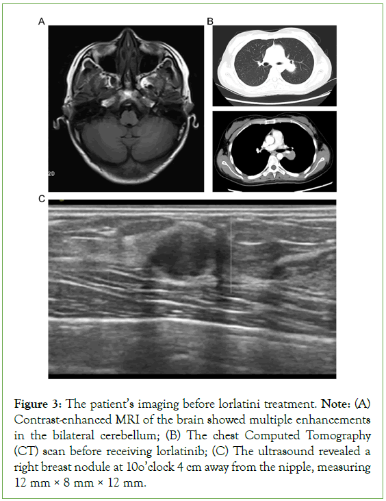 Mother-Child-lorlatinib