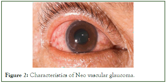 eye-diseases-Characteristics