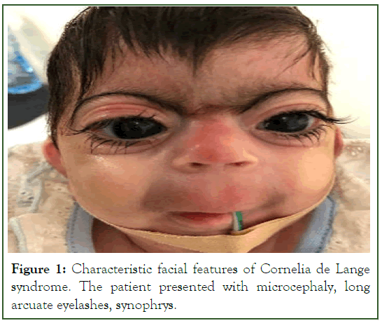 eye-diseases-Cornelia