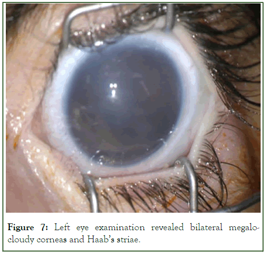 eye-diseases-bilateral