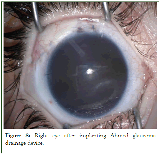 eye-diseases-drainage