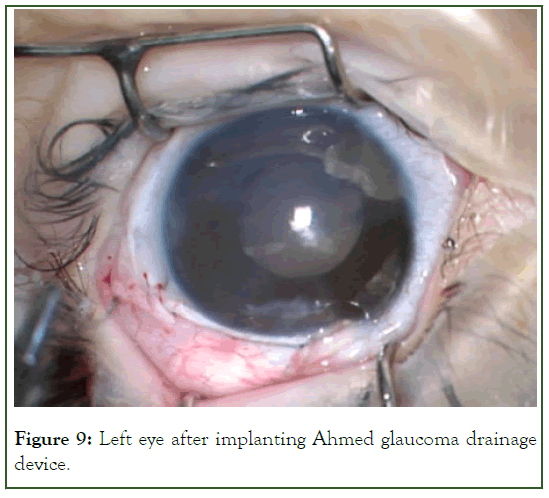 eye-diseases-glaucoma