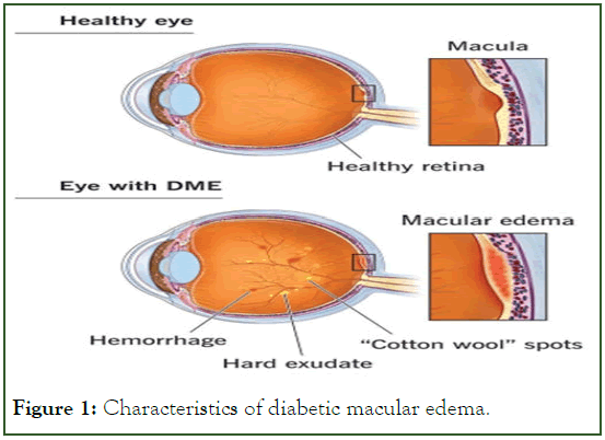 eye-diseases-macular
