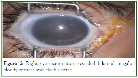 eye-diseases-megalocloudy