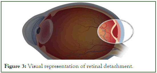 eye-diseases-retinal