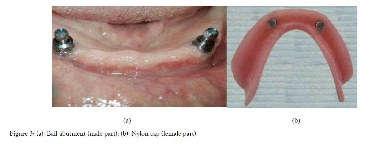 Dentistry-abutment