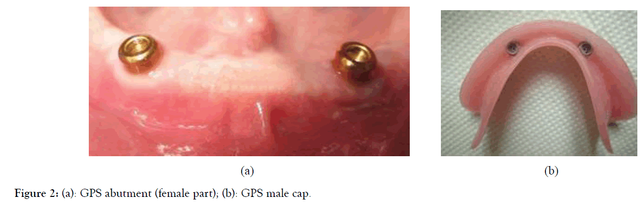 Dentistry-retention