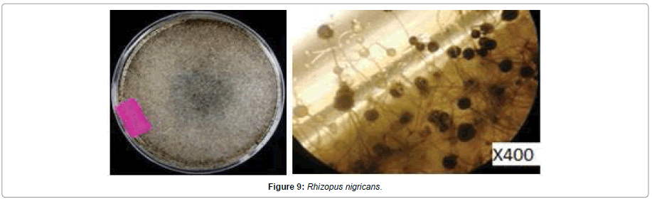 Pathology-Microbiology-nigricans