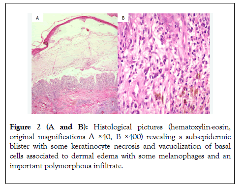 allergy-therapy-dermal-edema