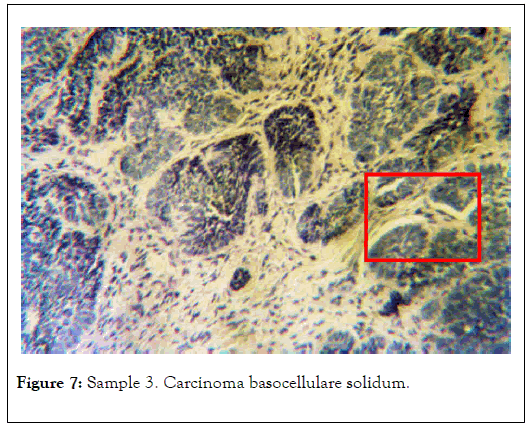 carcinogenesis-mutagenesis-basocellulare