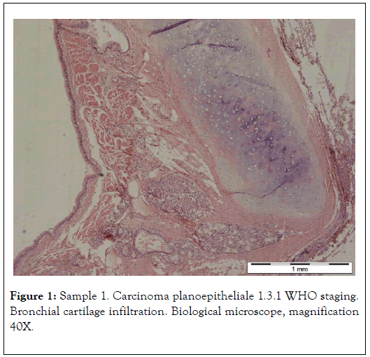 carcinogenesis-mutagenesis-planoepitheliale