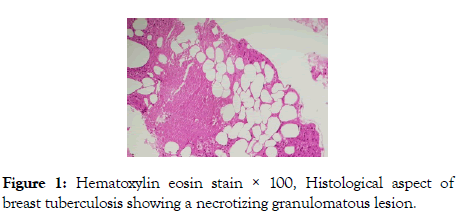 clinics-mother-child-health-necrotizing-granulomatous