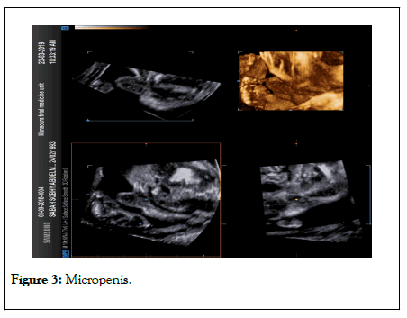 clinics-mother-micropenis