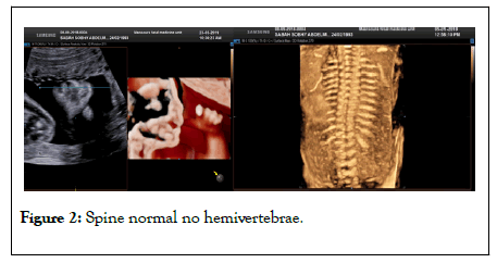 clinics-mother-spine-normal