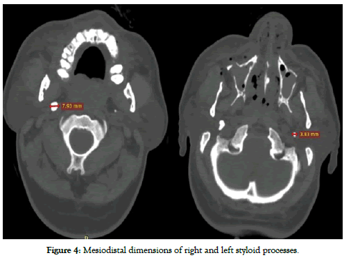 dentistry-Mesiodistal