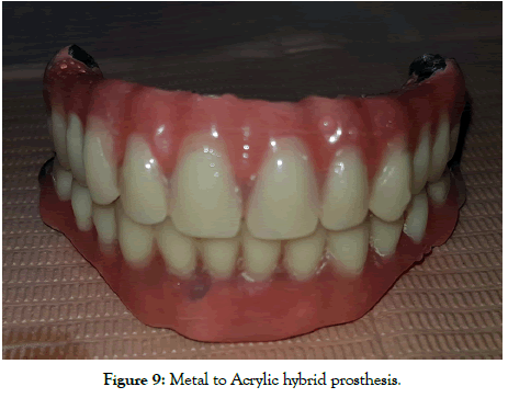 dentistry-acrylic