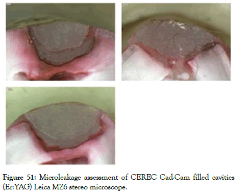 dentistry-cad-cam-filled-cavities