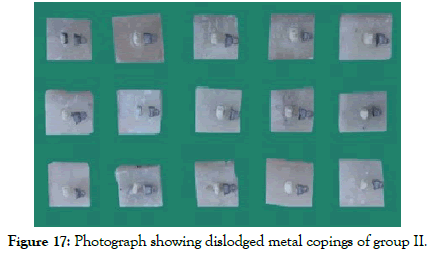 dentistry-dislodged-metal-copings