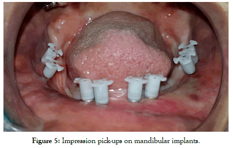 dentistry-impression-pickups