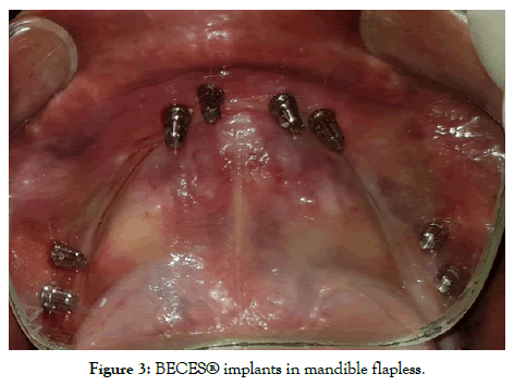 dentistry-mandible-flapless