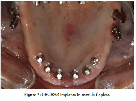 dentistry-maxilla-flapless