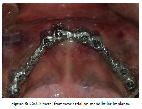 dentistry-metal-framework