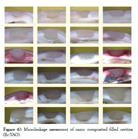 dentistry-microleakage