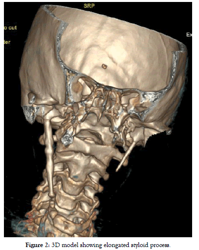 dentistry-styloid