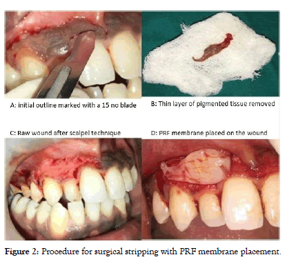 dentistry-surgical-stripping