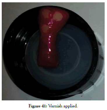 dentistry-varnish