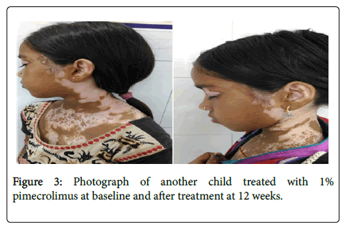 dermatitis-pimecrolimus