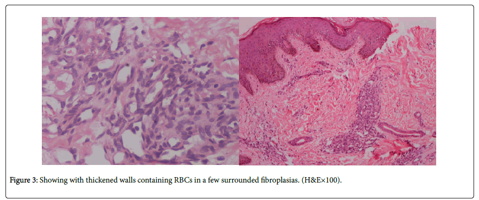 dermatitis-thickened-walls