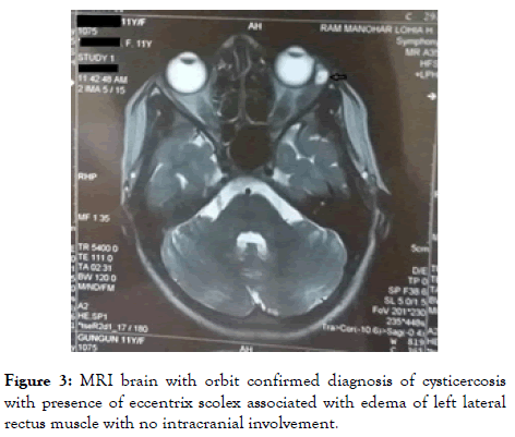 eye-diseases-MRI-brain
