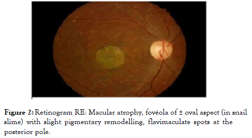 eye-diseases-Macular-atrophy