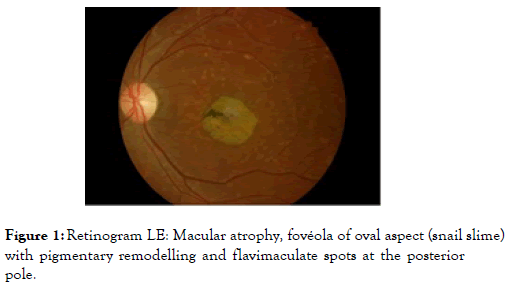 eye-diseases-Retinogram