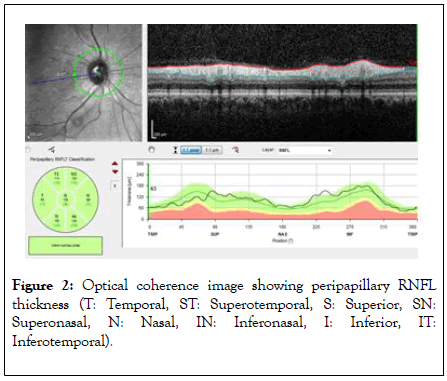 eye-diseases-and-disorders-Optical-coherence