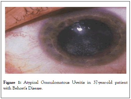 eye-diseases-disorders-Uveitis