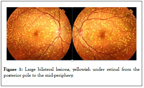 eye-diseases-disorders-bilateral