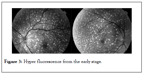 eye-diseases-disorders-early