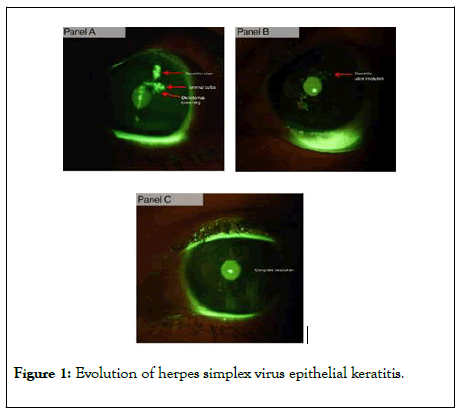 eye-diseases-disorders-herpes