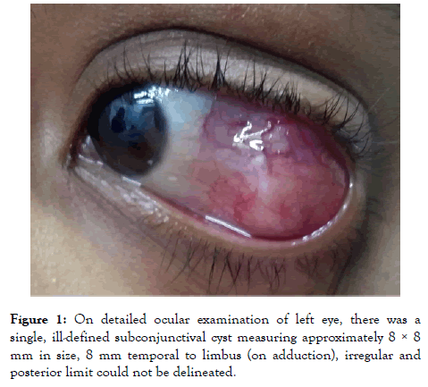 eye-diseases-left-eye