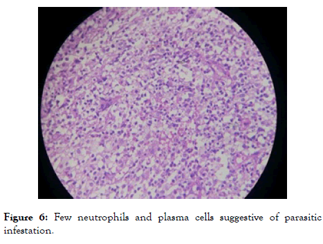 eye-diseases-plasma-cells