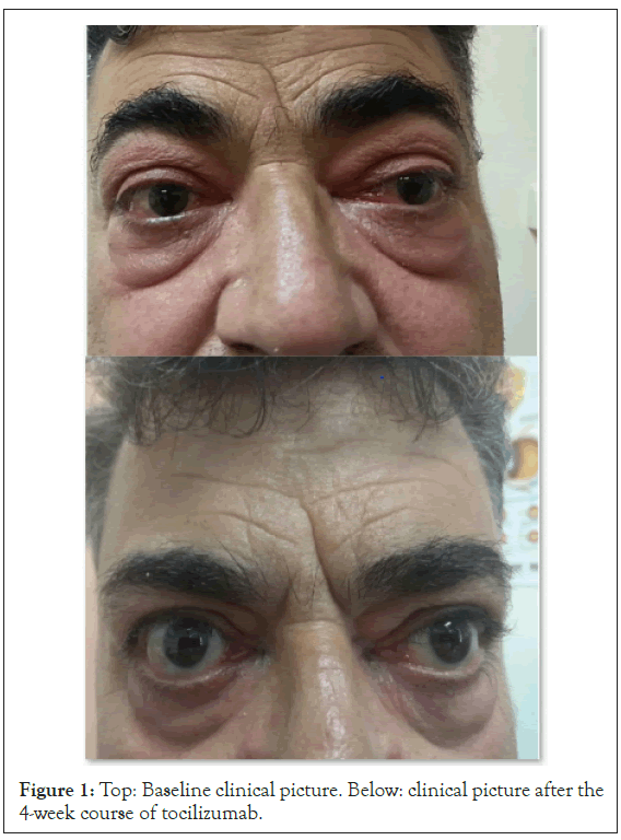 eye-diseases-tocilizumab