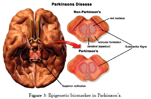 health-care-reviews-biomarker-Parkinson