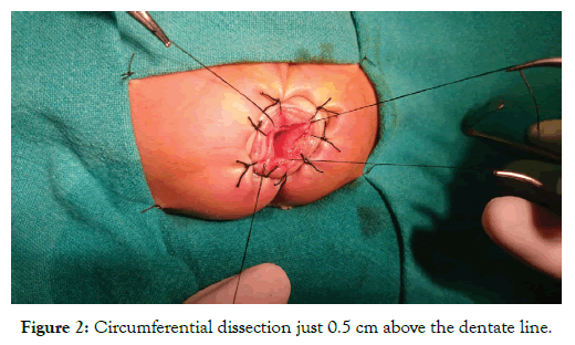 neonatal-biology-dentate-line