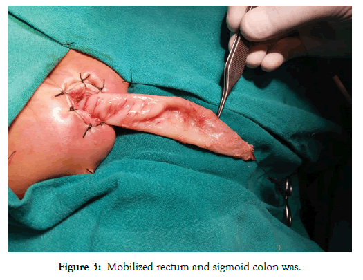 neonatal-biology-sigmoid-colon