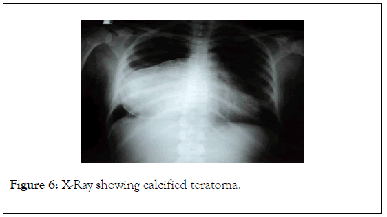 surgery-anesthesia-calcified